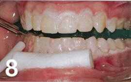 Методика кабинетного (офисного) отбеливания зубов с использованием системы Ораlеsсеnсе В00SТ РР.