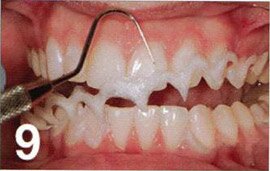 Методика кабинетного (офисного) отбеливания зубов с использованием системы Ораlеsсеnсе В00SТ РР.